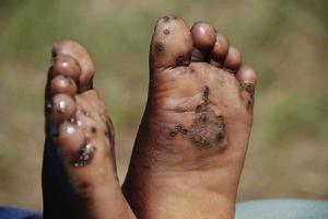 Jiggers usually affect the feet