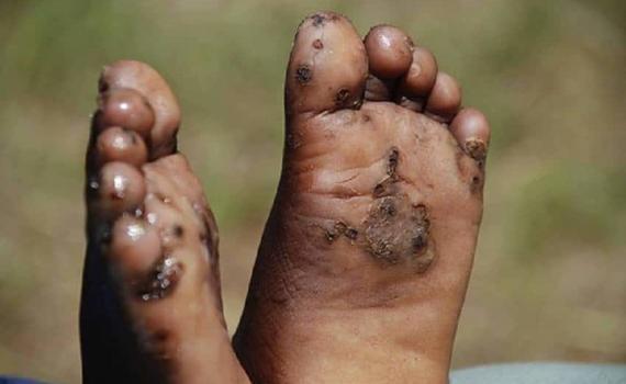 Jiggers usually affect the feet